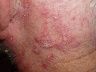 seborejnyj-psoriaz-klyuch-k-lecheniyu-patologii