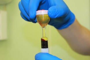 sekrety-liposovinga-i-osobennosti-prp-metoda-vzglyad-professora-mauritsio-chekkarelli