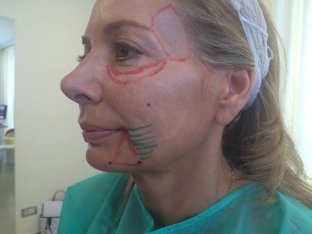 sekrety-raboty-s-patsientami-starshe-40-let-ot-professora-giammatteo-cecchini