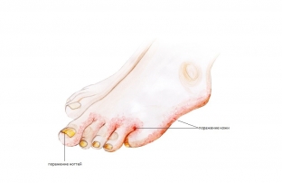 simptomy-lechenie-i-profilaktika-gribka-nogtej