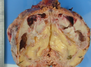 simptomy-pionefroza-kak-proyavlyaetsya-gnojnaya-destruktsiya-pochki