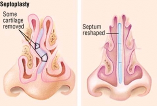 simptomy-prichiny-i-lechenie-iskrivleniya-nosovoj-peregorodki