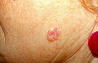 simptomy-prichiny-poyavleniya-i-metody-udaleniya-bazaliom