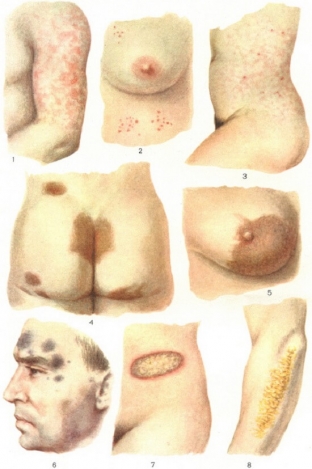 simptomy-toksikodermii-osnovnye-vidy-toksikodermij-i-ikh-proyavleniya