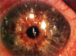sindrom-sukhogo-glaza-kak-oslozhnenie-blefaroplastiki