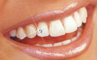 skajs-na-zub-ukrashaem-svoyu-ulybku-s-pomoshchyu-dentalnoj-inkrustatsii