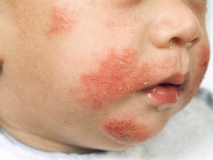 slozhnosti-i-oshibki-diagnostiki-atopicheskogo-dermatita-u-detej