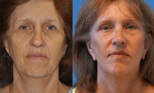 sluchaj-iz-praktiki-korrektsiya-vyrazhennykh-priznakov-stareniya