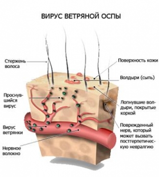 sovremennyj-podkhod-k-lecheniyu-opoyasyvayushchego-gerpesa
