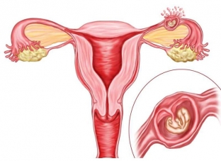 svoevremennaya-diagnostika-vnematochnoj-beremennosti-pomozhet-predotvratit-katastrofu