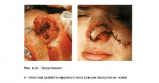 taktika-lecheniya-travm-nosa-kakoj-metod-vybrat