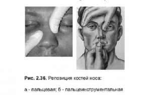 taktika-lecheniya-travm-nosa-kakoj-metod-vybrat