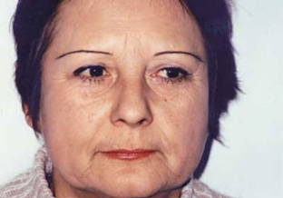taktika-vedeniya-patsientov-s-pogranichnymi-involyutsionnymi-izmeneniyami-vzaimodejstvie-dermatokosmetologov-i-plasticheskikh-khirurgov