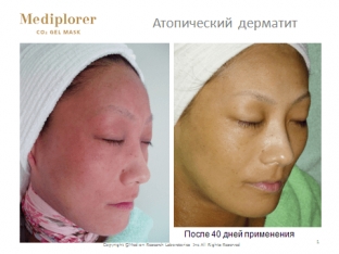 terapiya-atopicheskogo-dermatita-neinvazivnoj-karboksiterapiej-mediploer-yaponiya