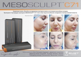 tonkost-linij-i-chetkij-oval-korrektsiya-ob-ema-litsa-preparatom-mesosculpt-c71tm