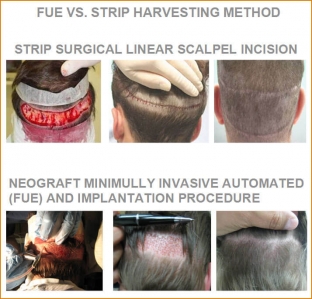 transplantatsiya-volos-metod-strip-vs-fue