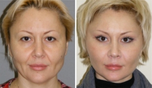 transplantatsiya-zhira-dlya-omolozheniya-srednej-treti-litsa