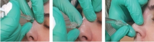 trekhtochechnaya-nekhirurgicheskaya-rinoplastika-tekhnika-provedeniya-i-rezultaty