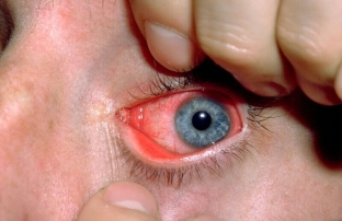 trevozhnye-simptomy-i-lechenie-khlamidijnogo-kon-yunktivita