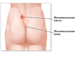 trevozhnye-simptomy-kotorye-ukazhut-chto-u-vas-pilonidalnaya-kista