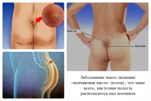 trevozhnye-simptomy-kotorye-ukazhut-chto-u-vas-pilonidalnaya-kista