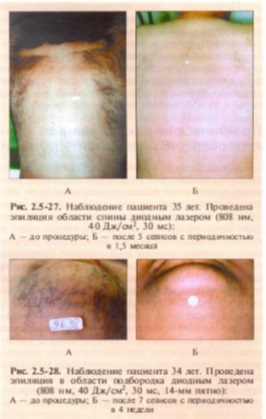 udalenie-nezhelatelnykh-volos-lazerom-effekty-i-rekomendatsii