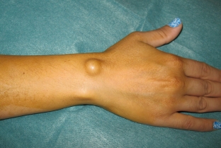 udalenie-novoobrazovanij-lazerom-ateromy-gigromy-lipomy
