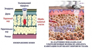 ultrazvukovaya-kavitatsiya-bezoperatsionnaya-liposaktsiya