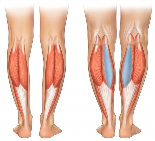 uvelichenie-goleni-implantatami-izbavit-ot-krivizny-nog