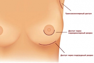 uvelichenie-grudi-pomozhet-realizovat-mechtu-o-krasivom-tele
