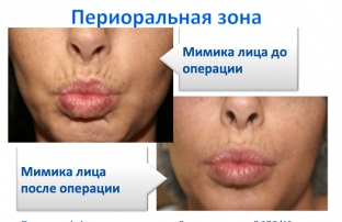 uvelichenie-gub-kak-dobitsya-idealnykh-proportsij-i-omolazhivayushchego-effekta