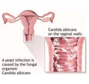 vaginalnyj-kandidoz-bolezn-snizhennogo-immuniteta