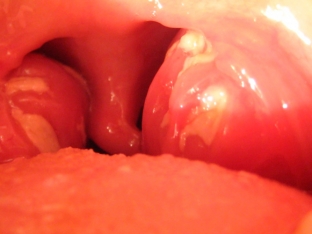 virus-epshtejn-barr-u-detej-simptomy-i-posledstviya