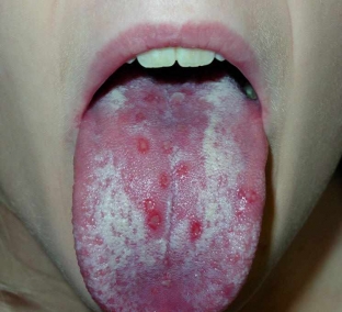 virus-epshtejn-barr-u-detej-simptomy-i-posledstviya