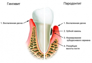 vospalenie-desen-prichiny-simptomy-lechenie