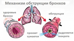 vydelenie-mokroty-v-gorle-s-chem-svyazano-i-chto-delat