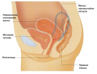 zagib-matki-osobennosti-klinicheskoj-kartiny-i-lecheniya