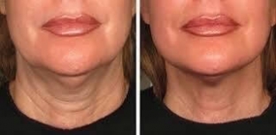 zhidkie-mezoniti-outline-gel-dlya-litsa-i-tela-osobennosti-primeneniya-i-effekt