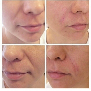 zhidkie-mezoniti-outline-gel-dlya-litsa-i-tela-osobennosti-primeneniya-i-effekt